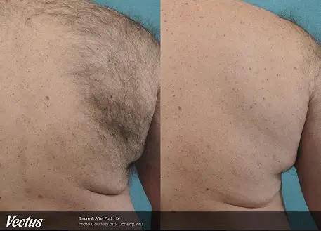 Vectus® Laser Hair Removal 2